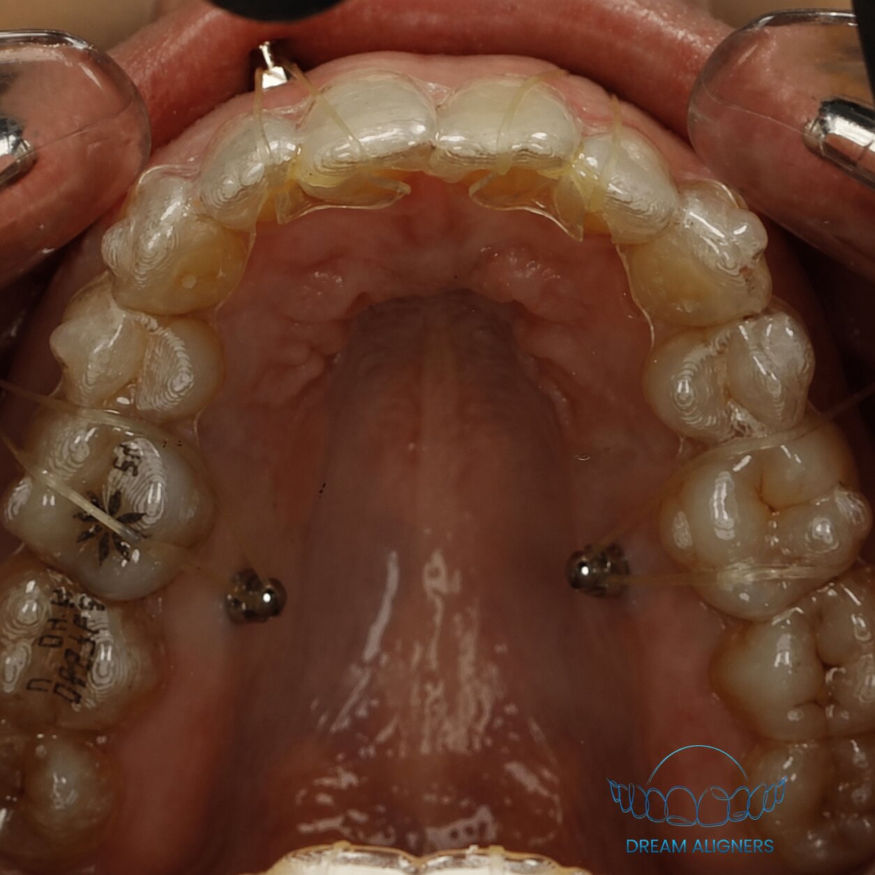 Dents alignées et sourire naturel après traitement Dream Aligners