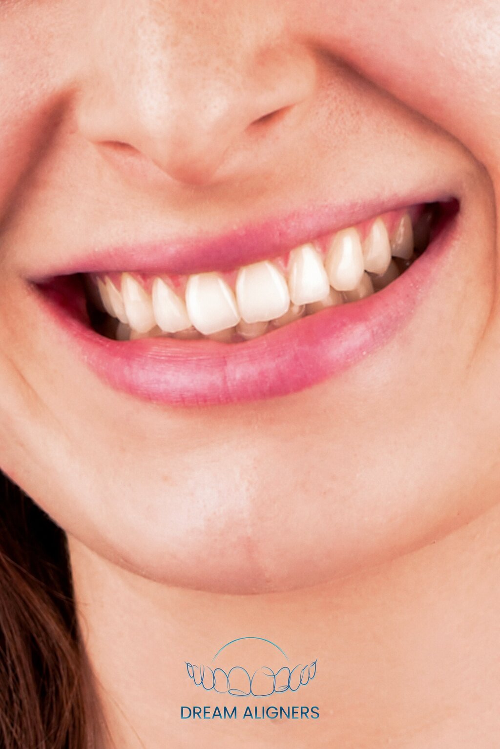 Femme au sourire éclatant grâce à ses aligneurs Dream Aligners