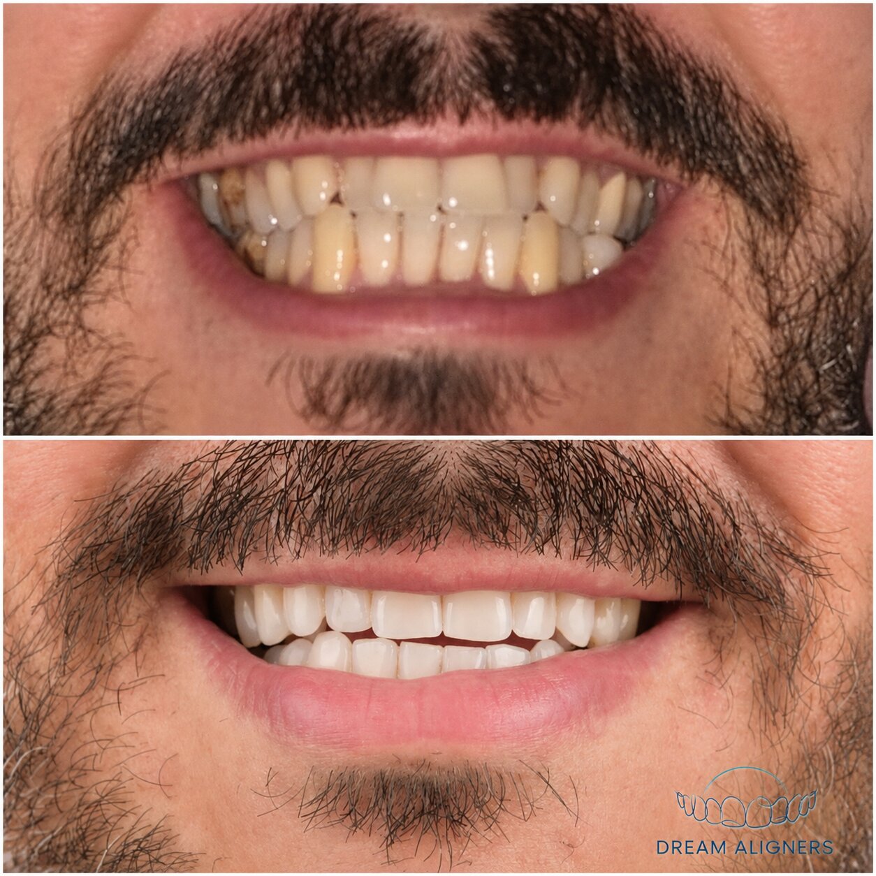 Sourire d'un patient avant et après traitement Dream Aligners